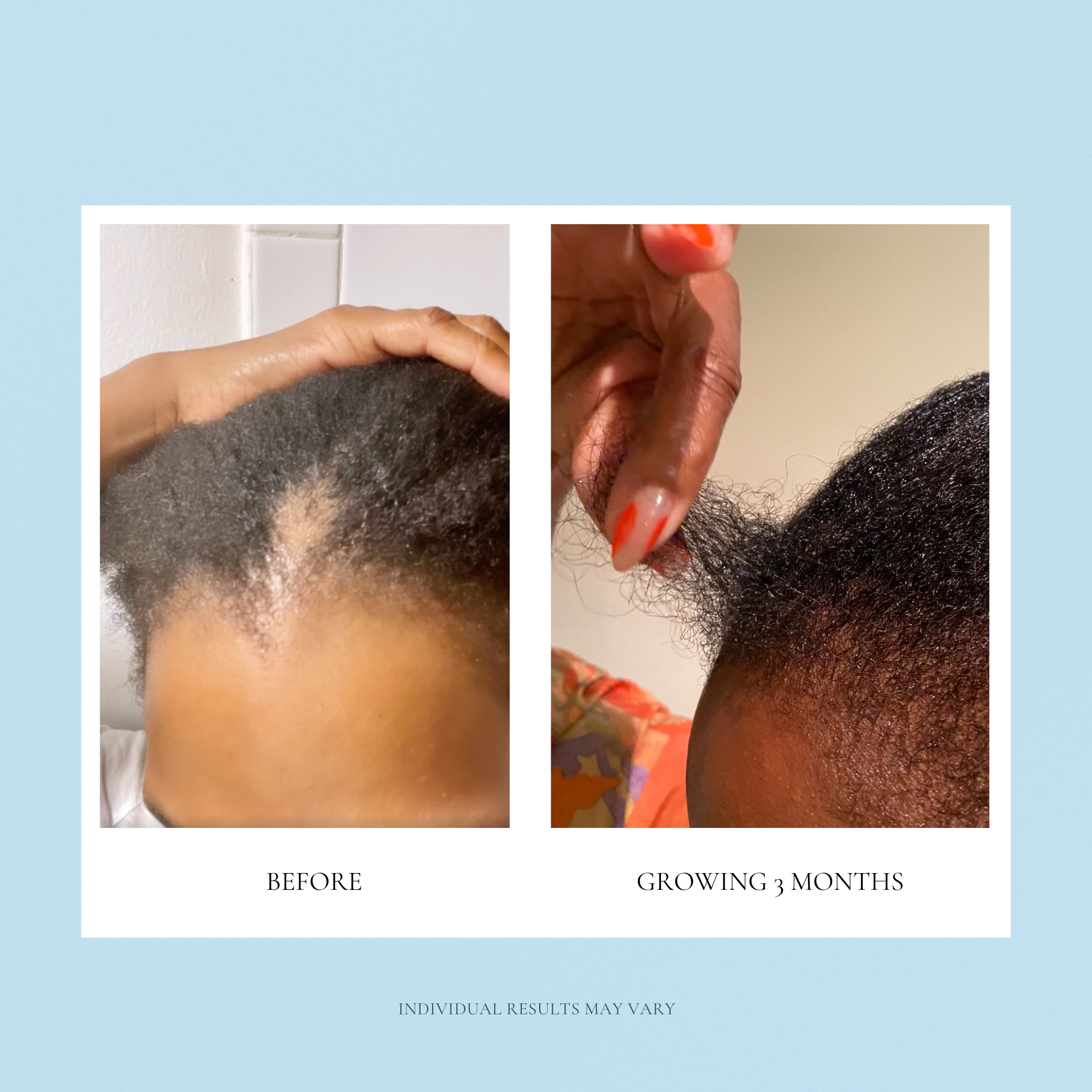 Tresse 3X Growth Factor & Microchannel Stamp – Medi Tresse At-home