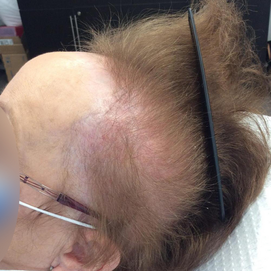 We Are Seeing More Patients With Scarring Alopecia