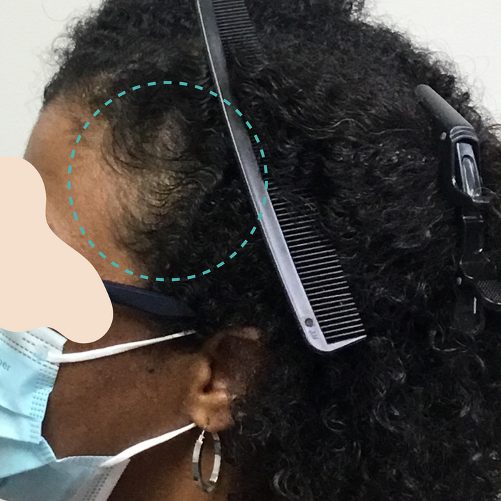 Female hair loss in the front temple before taking the Healthy Body Bundle